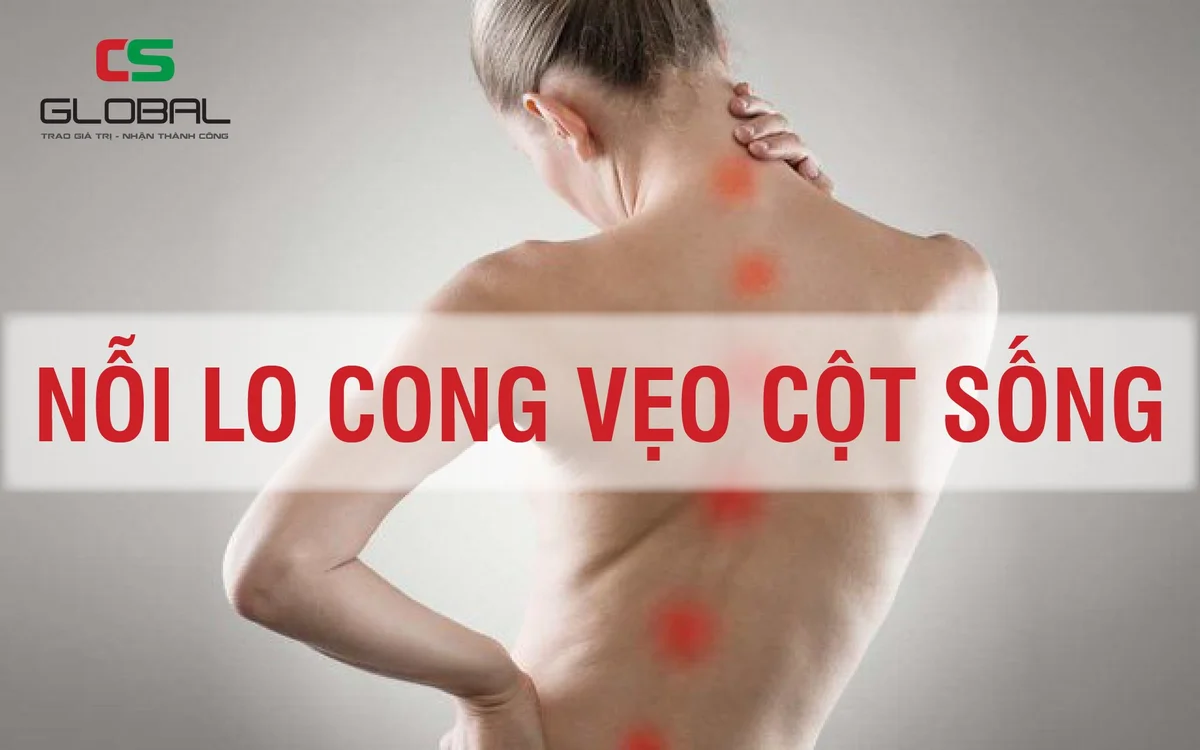 Nỗi lo cong vẹo cột sống